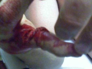 Illustration for article titled Blood Writes: This Man's Pinky Is Falling Off His Hand